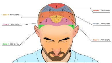 5000 Grafts Hair Transplant Cost Turkey 215 5000 4000 Grafts Hair Transplant Cost in Turkey