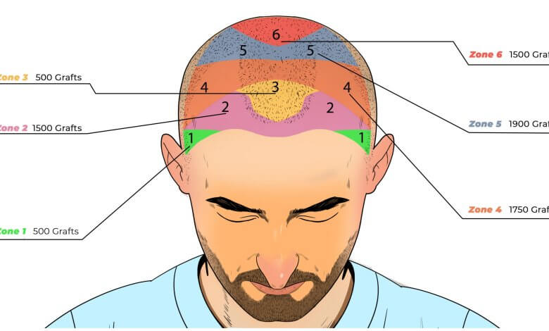 5000 Grafts Hair Transplant Cost Turkey 1 5000 4000 Grafts Hair Transplant Cost in Turkey