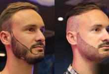 Beard Transplant in istanbul