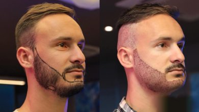 Beard Transplant in Istanbul 6 Beard Transplant in istanbul