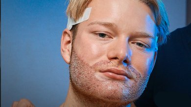 Beard Transplant Istanbul 21 Beard implants in istanbul