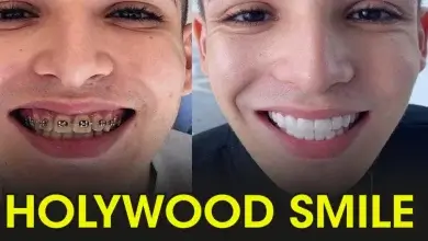 Cost and Prices of Hollywood Smile in turkey