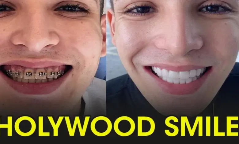 Hollywood Smile Turkey Price 1 Cost and Prices of Hollywood Smile in turkey