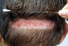 DHI Hair Transplantation