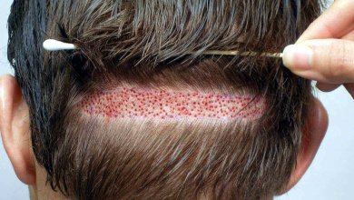 DHI Hair Transplant Turkey Cost 25 DHI Hair Transplantation