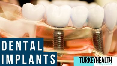 Dental Implants Istanbul 6 Dental implants in istanbul