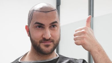 FUE Hair Transplant Istanbul 2 FUE Hair Transplant in istanbul