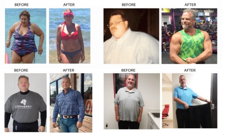 Gastric Sleeve Turkey Reviews 1 Gastric Sleeve in Turkey Reviews
