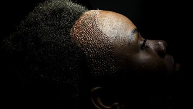 Female Hair Transplant Turkey Cost 1 Prices and Cost of Female Hair Transplant in Turkey