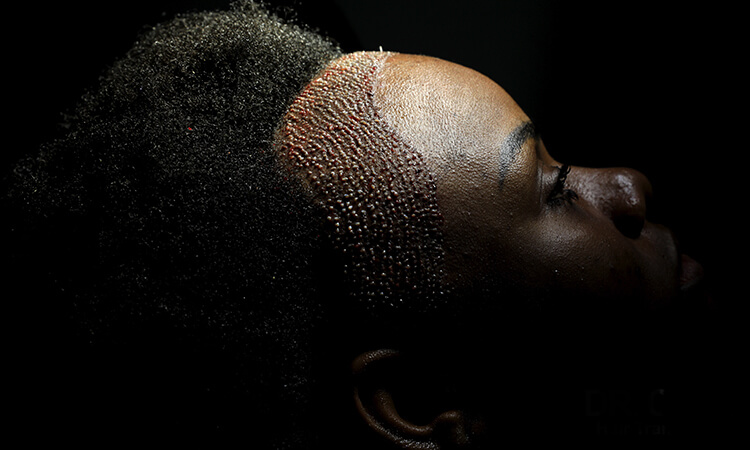 Female Hair Transplant Turkey Cost 1 Prices and Cost of Female Hair Transplant in Turkey
