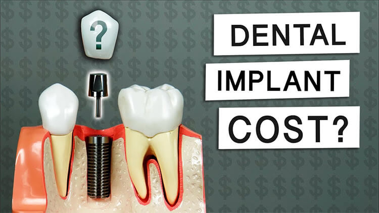 Tooth Implant Prices Turkey 1 Tooth implant Prices in Turkey