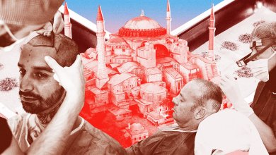 Top Hair Transplant in Istanbul 19 Top Hair Transplant in istanbul