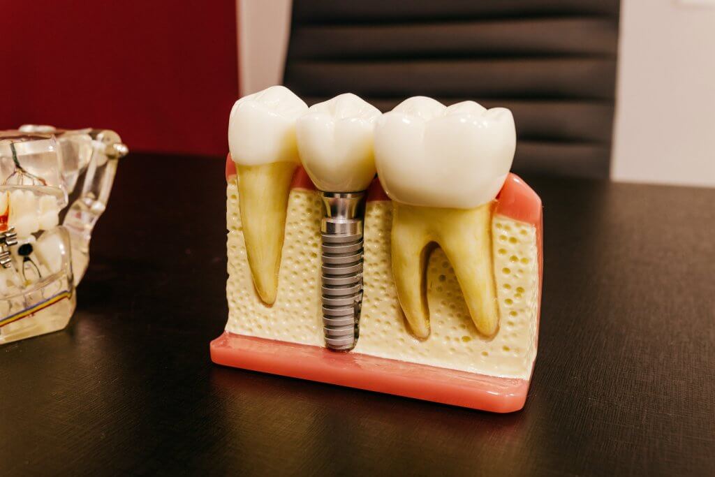 Dental Implants Istanbul 2 dental implant cost turkey