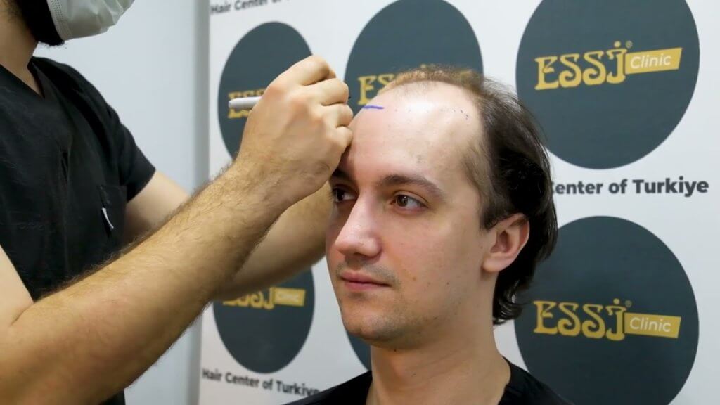 essi hair transplant clinic izmir