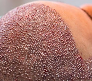 Hair Transplant in Marmaris 22