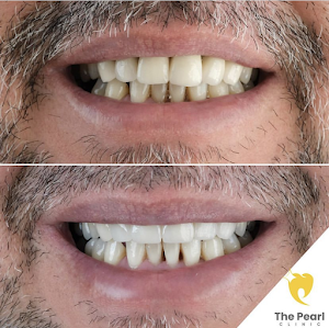 Antalya Dental Implants 25