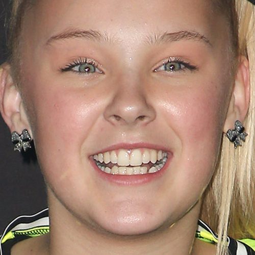 Jojo Siwa Veneers - Before & After 2 jojo siwa teeth