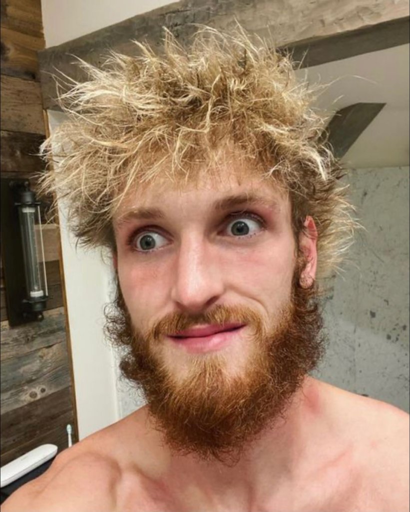 Logan Paul Hair Transplant - Before & After 3 logan paul hair