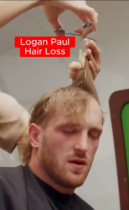 Logan Paul Hair Transplant - Before & After 2 logan paul hair loss