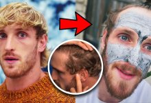 logan paul hair transplant