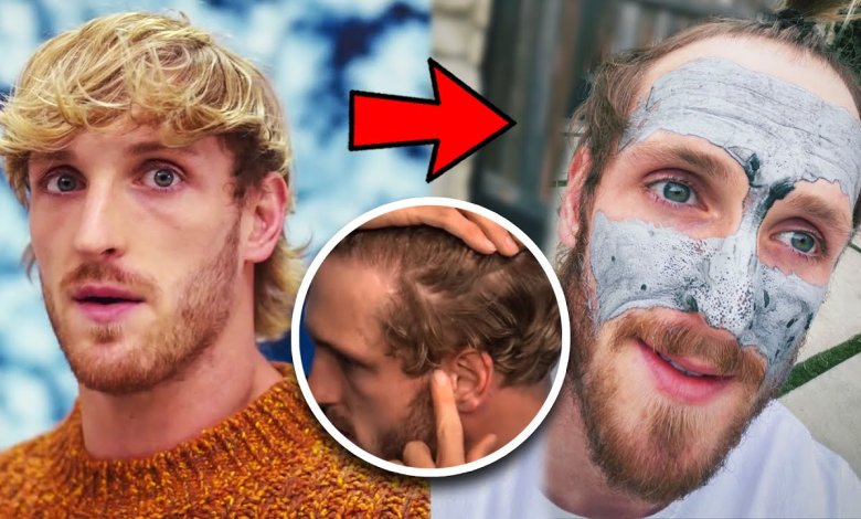 Logan Paul Hair Transplant - Before & After 1 logan paul hair transplant