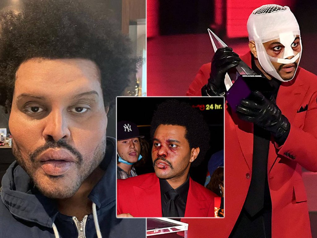 the weeknd face surgery